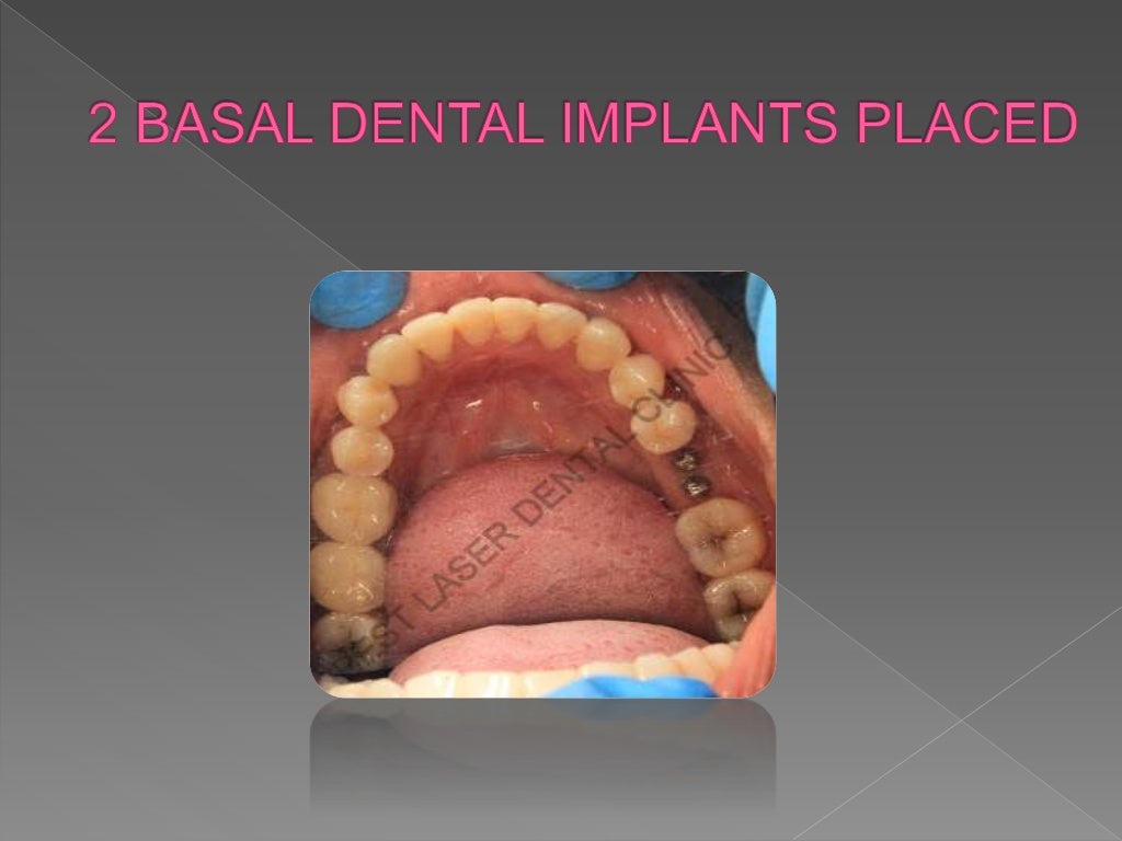 Molar infected root stumps extraction and implant placement