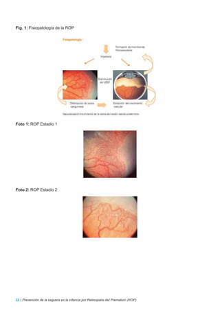 Fig. 1: Fisiopatología de la ROP




Foto 1: ROP Estadio 1




Foto 2: ROP Estadio 2




22 | Prevención de la ceguera en la infancia por Retinopatía del Prematuro (ROP)
 