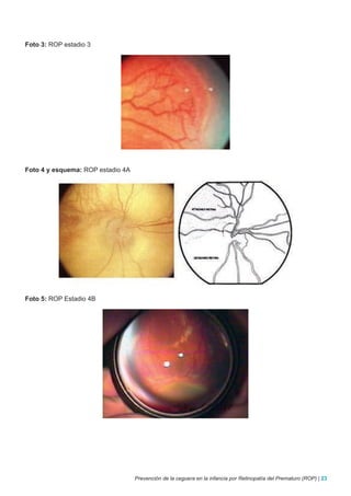 Foto 3: ROP estadio 3




Foto 4 y esquema: ROP estadio 4A




Foto 5: ROP Estadio 4B




                                   Prevención de la ceguera en la infancia por Retinopatía del Prematuro (ROP) | 23
 