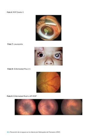 Foto 6: ROP Estadio 5




Foto 7: Leucocoria




Foto 8: Enfermedad Plus (+)




Foto 9: Enfermedad Rush o AP-ROP




24 | Prevención de la ceguera en la infancia por Retinopatía del Prematuro (ROP)
 