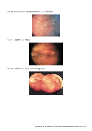 Foto 10: Vascularización en la zona anterior a la anastomosis




Foto 11: Tracción de la mácula




Foto 12: Tracción de la papila post-criocoagulación




                                     Prevención de la ceguera en la infancia por Retinopatía del Prematuro (ROP) | 25
 