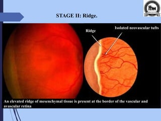 Retinopathy of pre-maturity (ROP) | PDF