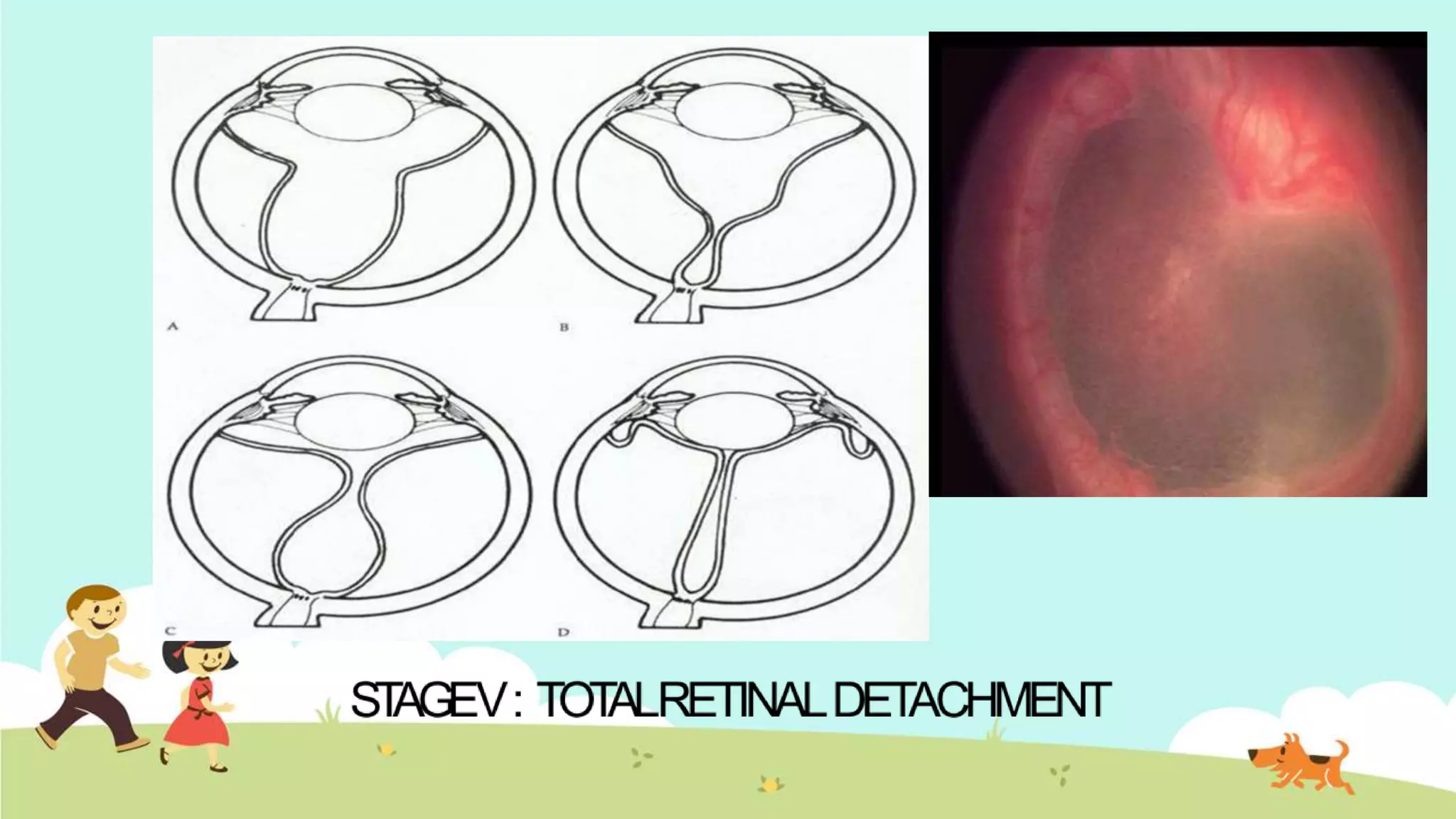Retinopathi Rop Retinopathy of prematurity | PPTX