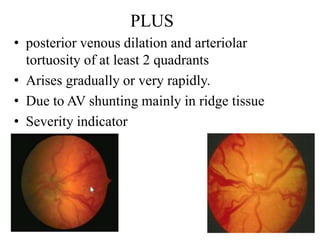 Vascular Ridge Rop Rop Retinopathy of prematurity | PPTX