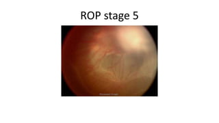 Retinopathy of prematurity | PPTX