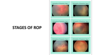 Retinopathy of Prematurity.pptx