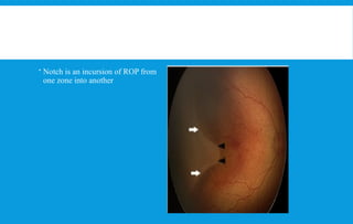 Retinopathy of prematurity ICROP 3 guidelines | PPTX