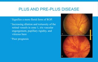 Retinopathy of prematurity ICROP 3 guidelines | PPTX