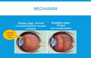 Retinopathy of prematurity ICROP 3 guidelines | PPTX