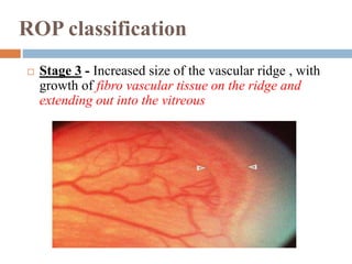 Retinopathy of prematurity | PPTX