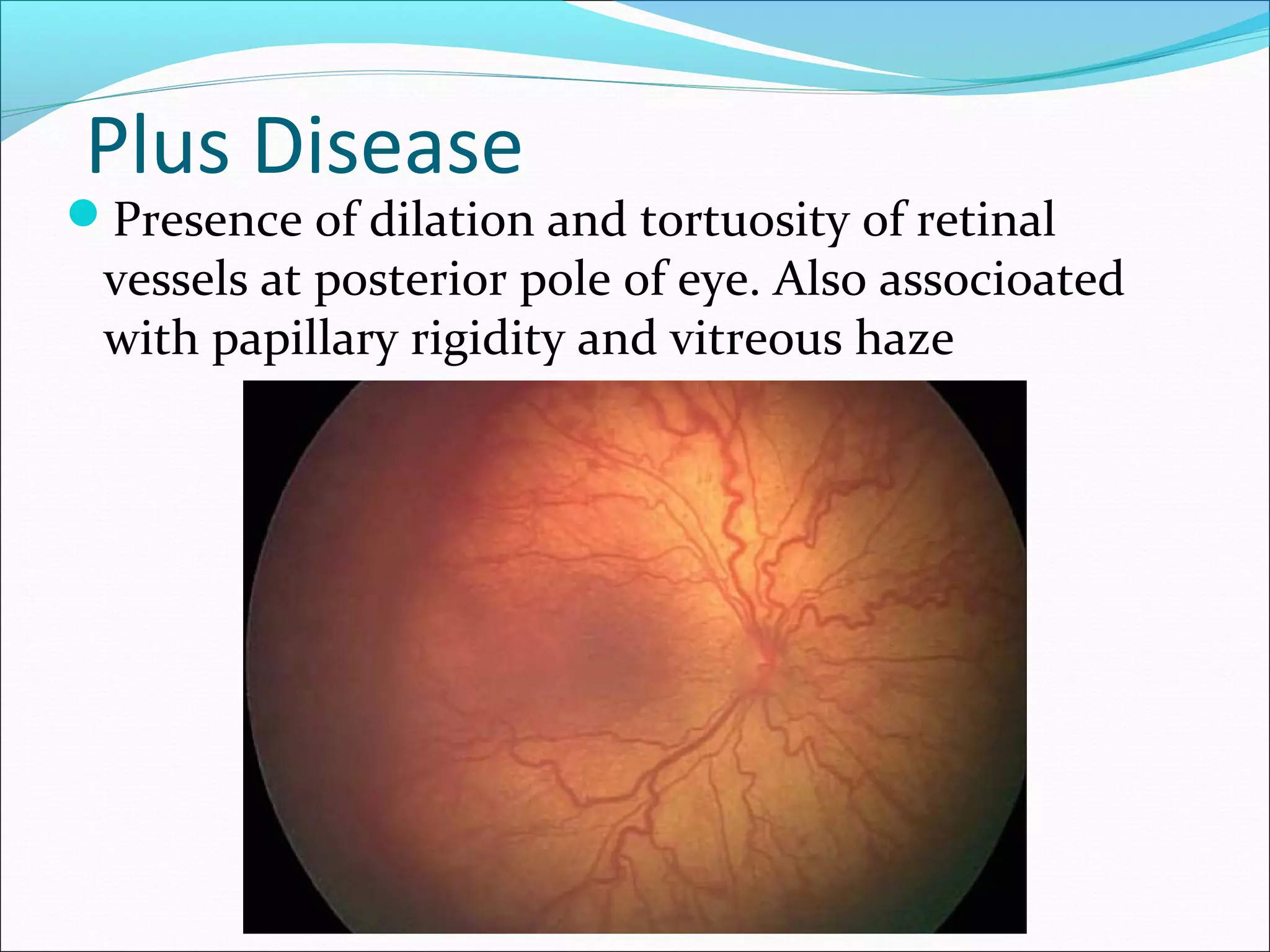 Plus Disease
Presence of dilation and tortuosity of retinal
vessels at posterior pole of eye. Also associoated
with papillary rigidity and vitreous haze
 