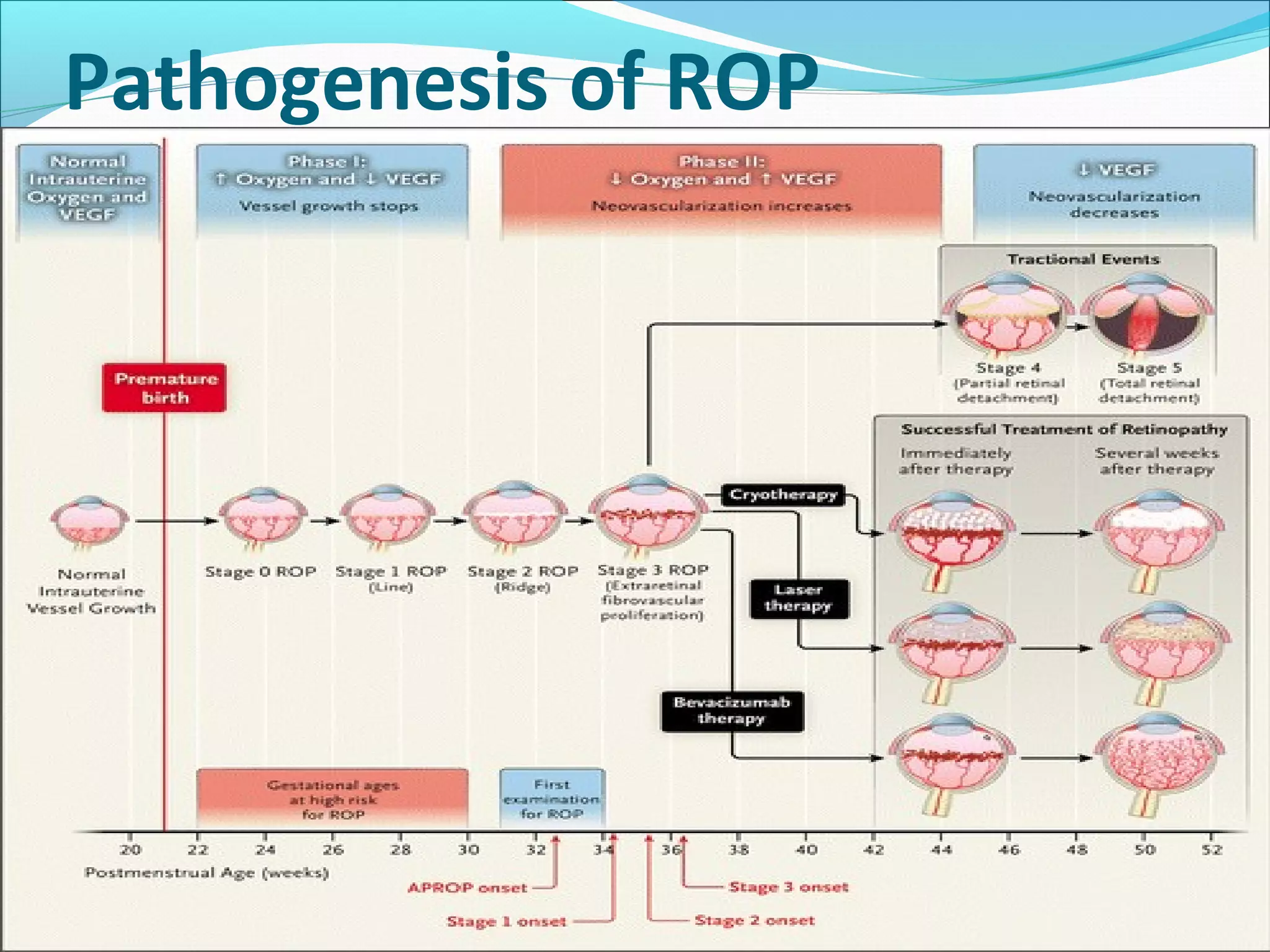 Pathogenesis of ROP
 