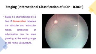 Staging (International Classification of ROP – ICROP)
• Stage I is characterized by a
line of demarcation between
the vascular and avascular
retina. Branching or
arborization can be seen
growing at the leading edge
of the retinal vasculature.
 