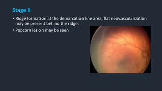 Stage II
• Ridge formation at the demarcation line area, flat neovascularization
may be present behind the ridge.
• Popcorn lesion may be seen
 
