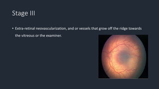 Stage III
• Extra-retinal neovascularization, and or vessels that grow off the ridge towards
the vitreous or the examiner.
 