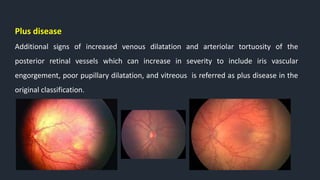 Plus disease
Additional signs of increased venous dilatation and arteriolar tortuosity of the
posterior retinal vessels which can increase in severity to include iris vascular
engorgement, poor pupillary dilatation, and vitreous is referred as plus disease in the
original classification.
 