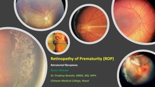 Retinopathy of Prematurity (ROP)
Retrolental fibroplasia
Terry’s Disease
Dr. Pradeep Bastola, MBBS, MD, MPH
Chitwan Medical College, Nepal
 