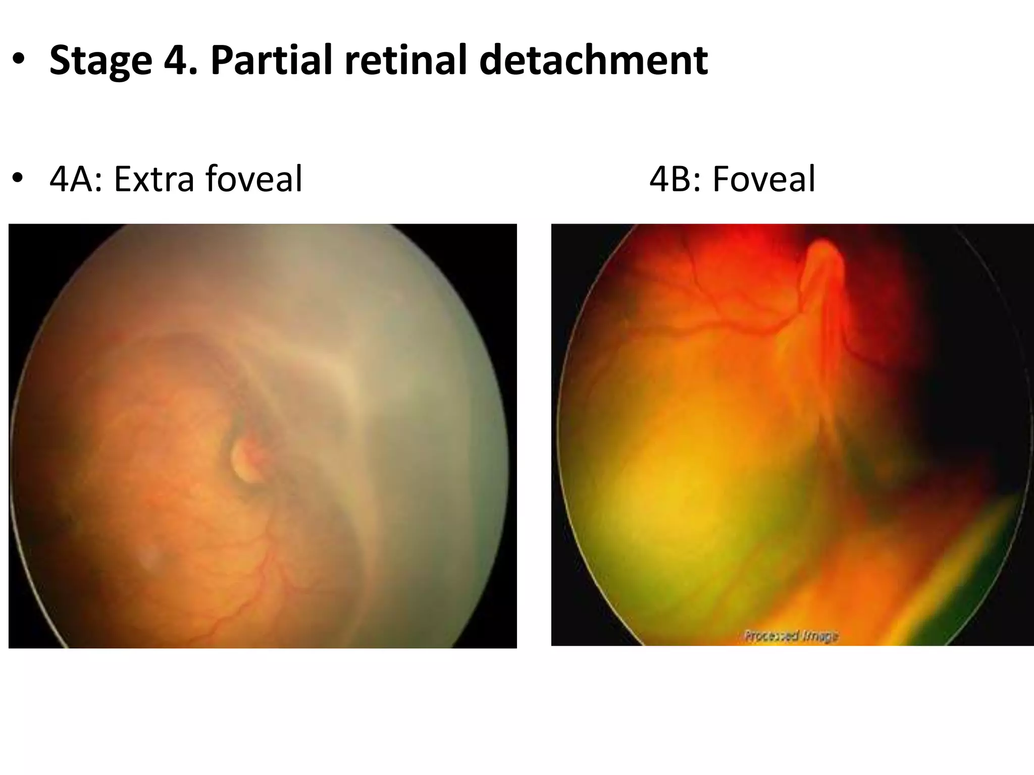 ROP - Dr Padmesh - Neonatology | PPTX