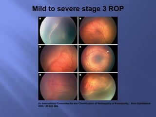 An International Committee for the Classification of Retinopathy of Prematurity,  Arch Ophthalmol 2005;123:991-999. Mild to severe stage 3 ROP 