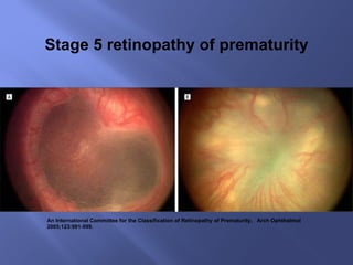 An International Committee for the Classification of Retinopathy of Prematurity,  Arch Ophthalmol 2005;123:991-999. Stage 5 retinopathy of prematurity 