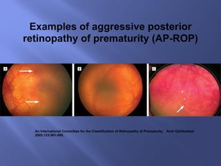 An International Committee for the Classification of Retinopathy of Prematurity,  Arch Ophthalmol 2005;123:991-999. Examples of aggressive posterior retinopathy of prematurity (AP-ROP) 
