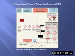 Pathogenesis and Therapy of Retinopathy of Prematurity (ROP). Mintz-Hittner HA et al. N Engl J Med 2011;364:603-615 