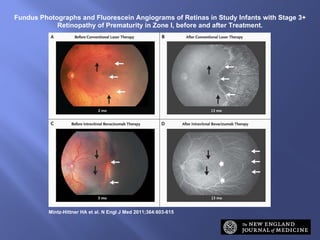 Fundus Photographs and Fluorescein Angiograms of Retinas in Study Infants with Stage 3+ Retinopathy of Prematurity in Zone I, before and after Treatment. Mintz-Hittner HA et al. N Engl J Med 2011;364:603-615 