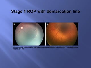 An International Committee for the Classification of Retinopathy of Prematurity,  Arch Ophthalmol 2005;123:991-999. Stage 1 ROP with demarcation line 