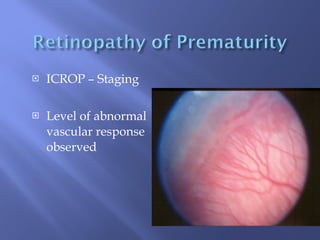 ICROP – Staging Level of abnormal vascular response observed 
