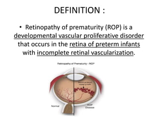 DEFINITION :
• Retinopathy of prematurity (ROP) is a
developmental vascular proliferative disorder
that occurs in the retina of preterm infants
with incomplete retinal vascularization.
 
