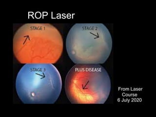 ROP Laser
From Laser
Course
6 July 2020
 