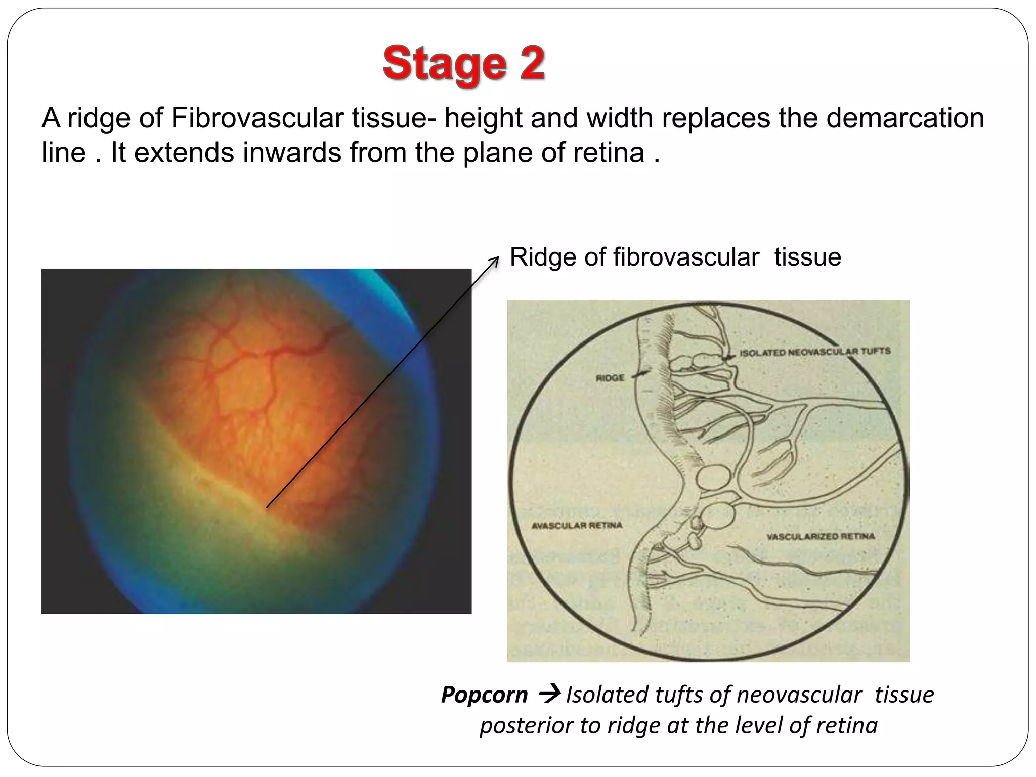 retinopathy of prematurity | PPTX