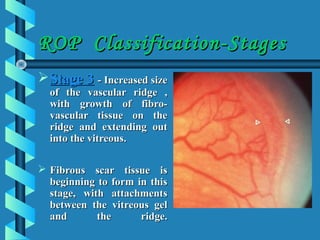 Vascular Ridge Rop Retinopathy of prematurity | PPT