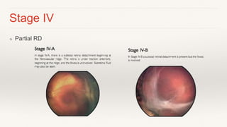 Retinopathy of Prematurity | PPTX