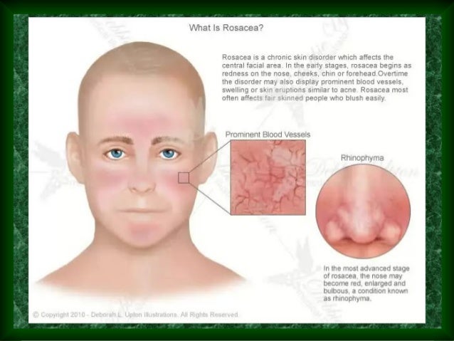 Ocular Rosacea - Information, Symptoms & Treatment
