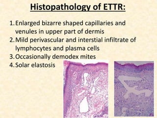 Histopathology of ETTR:
1.Enlarged bizarre shaped capillaries and
venules in upper part of dermis
2.Mild perivascular and interstial infiltrate of
lymphocytes and plasma cells
3.Occasionally demodex mites
4.Solar elastosis
 