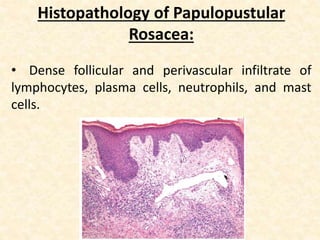 Histopathology of Papulopustular
Rosacea:
• Dense follicular and perivascular infiltrate of
lymphocytes, plasma cells, neutrophils, and mast
cells.
 