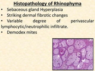 Histopathology of Rhinophyma
• Sebaceous gland Hyperplasia
• Striking dermal fibrotic changes
• Variable degree of perivascular
lymphocytic/neutrophilic infiltrate.
• Demodex mites
 