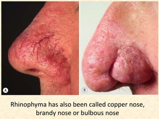 Rhinophyma has also been called copper nose,
brandy nose or bulbous nose
 