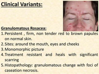 Clinical Variants:
Granulomatous Rosacea:
1.Persistent , firm, non tender red to brown papules
on normal skin.
2.Sites: around the mouth, eyes and cheeks
3.Monomorphic picture
4.Treatment resistant and heals with significant
scarring
5.Histopathology: granulomatous change with foci of
caseation necrosis.
 