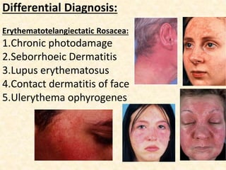 Differential Diagnosis:
Erythematotelangiectatic Rosacea:
1.Chronic photodamage
2.Seborrhoeic Dermatitis
3.Lupus erythematosus
4.Contact dermatitis of face
5.Ulerythema ophyrogenes
 