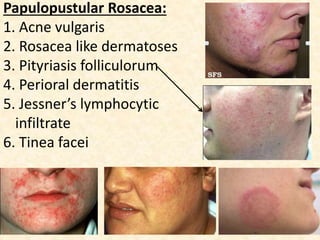 Papulopustular Rosacea:
1. Acne vulgaris
2. Rosacea like dermatoses
3. Pityriasis folliculorum
4. Perioral dermatitis
5. Jessner’s lymphocytic
infiltrate
6. Tinea facei
 