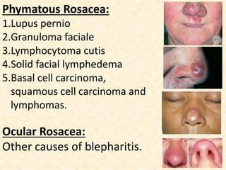 Phymatous Rosacea:
1.Lupus pernio
2.Granuloma faciale
3.Lymphocytoma cutis
4.Solid facial lymphedema
5.Basal cell carcinoma,
squamous cell carcinoma and
lymphomas.
Ocular Rosacea:
Other causes of blepharitis.
 