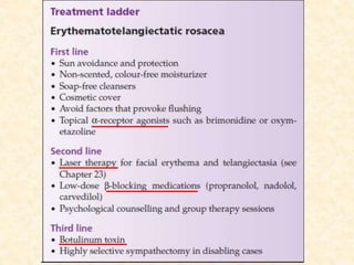 Rosacea: Inflammatory condition in Dermatology