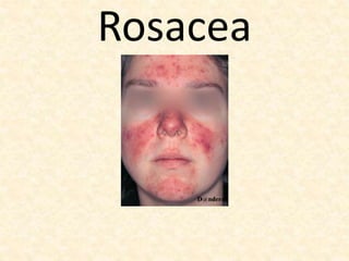 Rosacea
 
