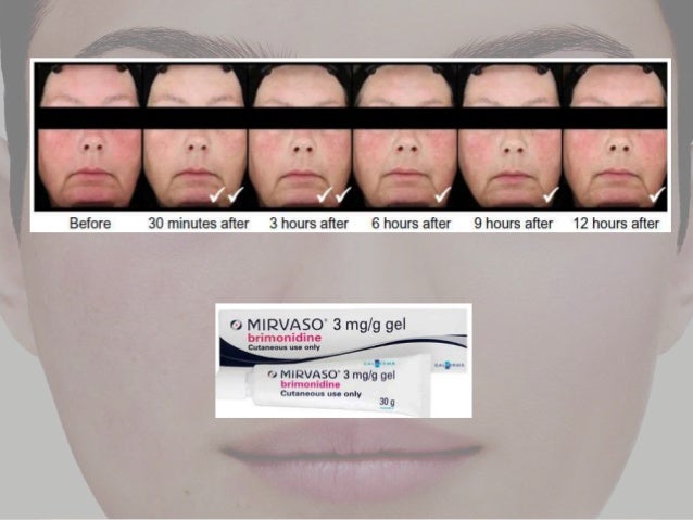 ivermectin topical rosacea