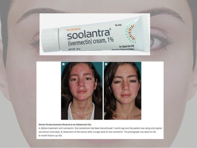 soolantra twice a day