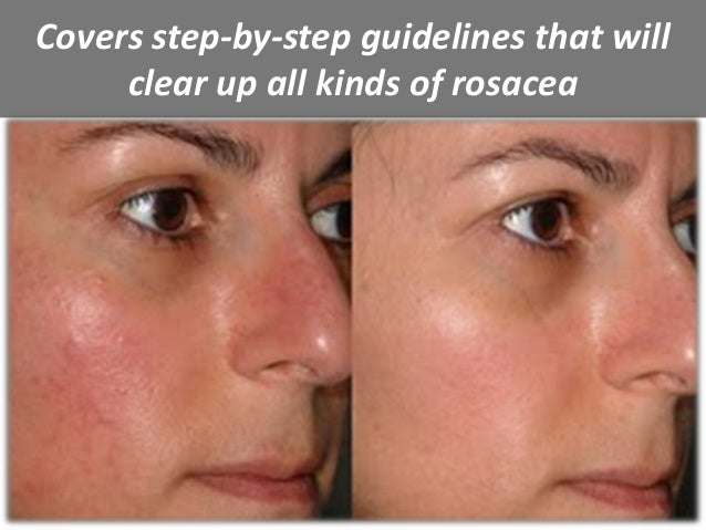 Rosacea free forever is the best treatment for curing Rosacea