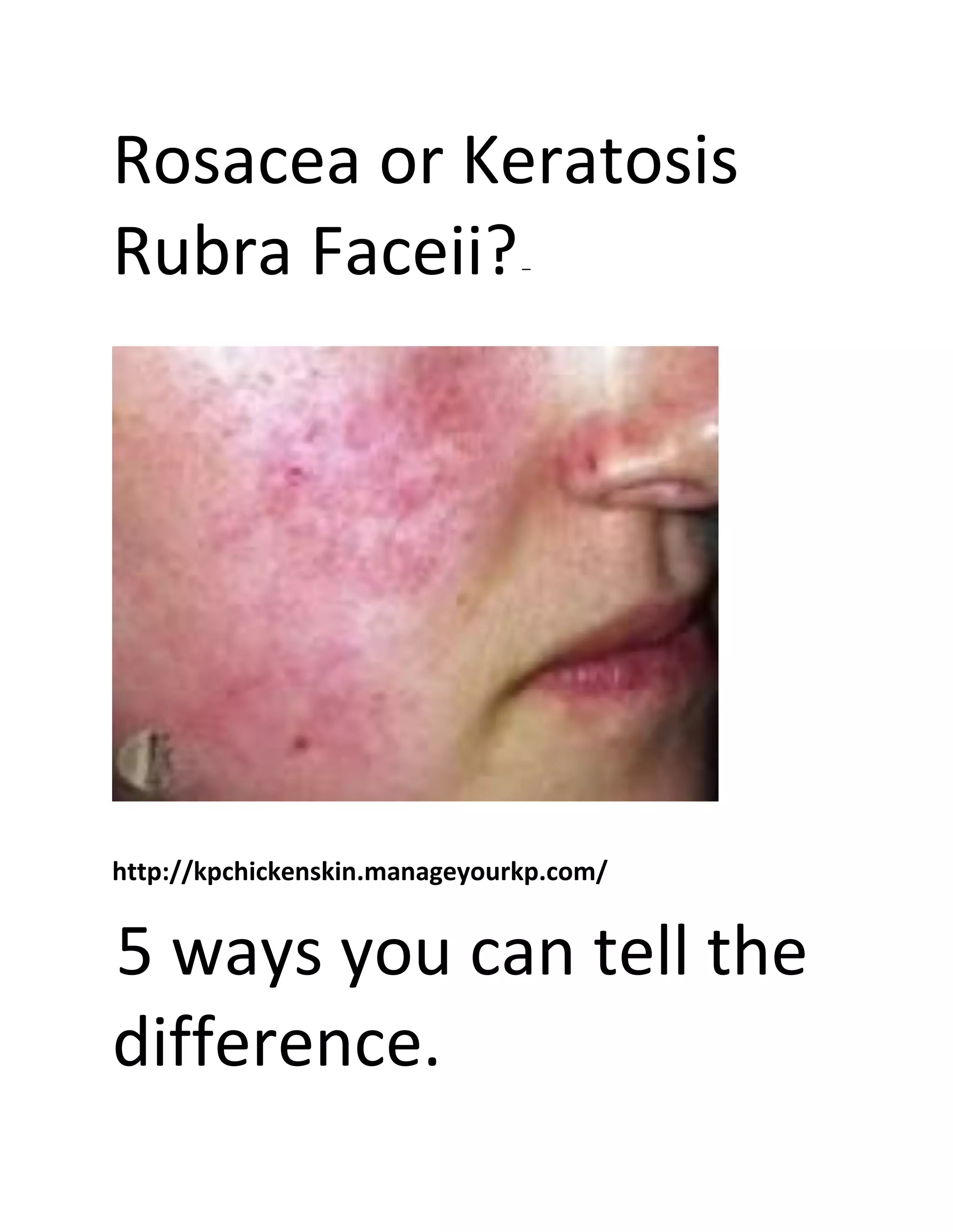 Skin Rubera Rosacea or keratosis rubra faceii | PDF