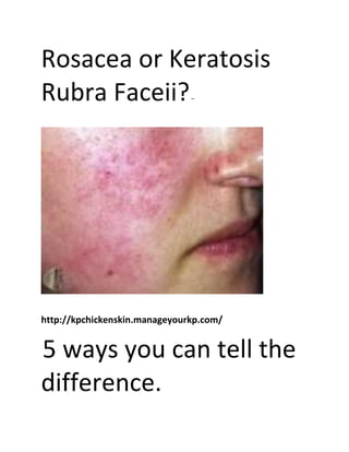 Rosacea or Keratosis
Rubra Faceii?–
http://kpchickenskin.manageyourkp.com/
5 ways you can tell the
difference.
 